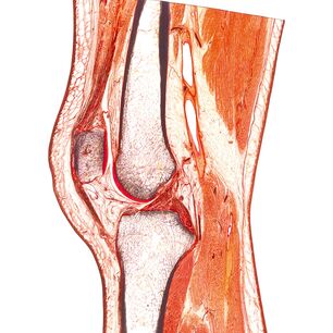 Anatomischer Digitaldruck eines menschlichen Kniegelenks auf Acrylglas, präzise im Konturzuschnitt mit der eurolaser XL-Line Laserschneidmaschine gefertigt