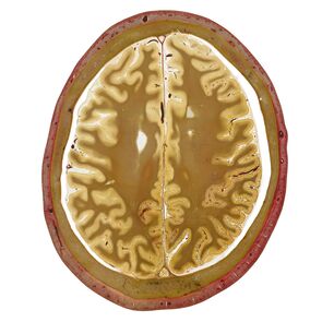 Horizontal dargestellter Anatomie-Digitaldruck eines menschlichen Kopfes auf Acrylglas, präzise konturgeschnitten mit der eurolaser XL-Line Laserschneidmaschine
